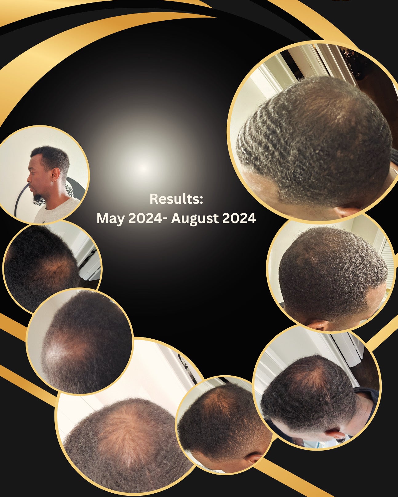 Hair growth progression collage from May 2024 to August 2024 with multiple angle shots.